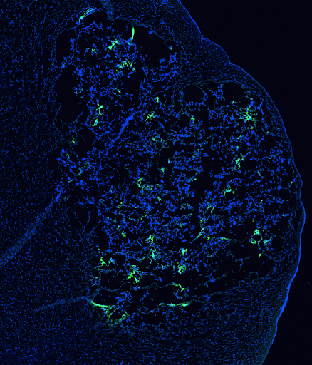 Zoomed-in view of the tumor region from the coronal section, showing dense peptide signal within the tumor margin
